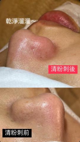 Moonis沐尼斯美療 - 手工清粉刺