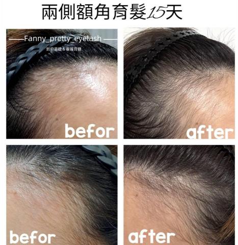 Fanny_pretty_eyelash - 兩側額角稀疏問題者