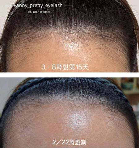 Fanny_pretty_eyelash - 髮際線退後困擾者