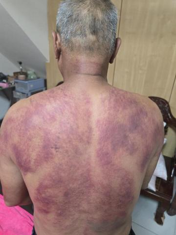 斌師傅整復推拿 - 刮痧