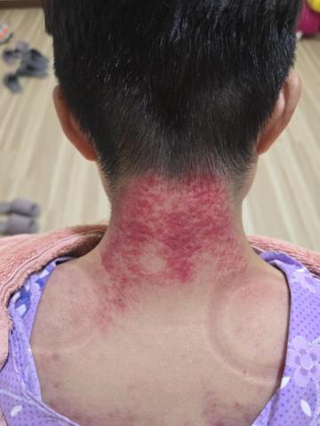 斌師傅整復推拿 - 刮痧