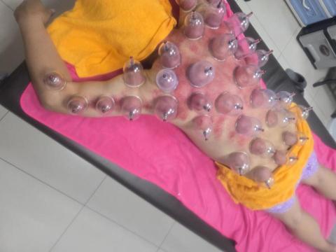 斌師傅整復推拿 - 拔罐