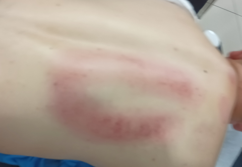 我自在傳統整復推拿工作室 - 滑罐刮痧調理