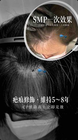 zoYOU左右頭皮美學 - SMP一次效果/共三次