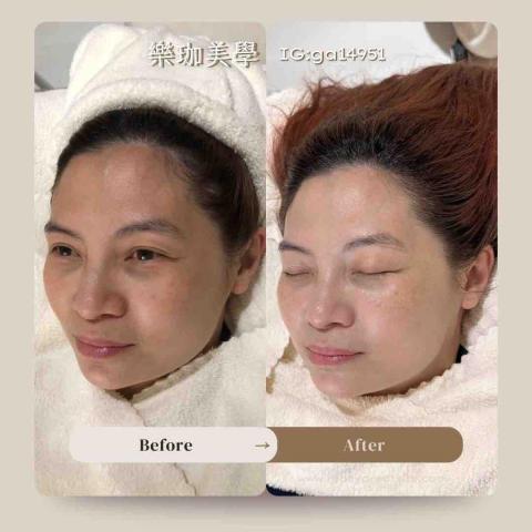 樂珈美學 - ✨ 清爽A套裝
經典淨化美顏+T字粉刺調理 
推薦:T字部位粉刺清理
✨ 【加購】水光注肌修護
結合專業儀器,將高效精華(石榴、葡聚醣、無花果)深層導入肌底,有效幫助肌膚鎮靜與修護,搭配冷導收縮毛孔,提升肌膚緊緻度與透亮感,讓肌膚喝飽營養、細緻滑嫩。
 樂珈美學 - ✨ 清爽A套裝
經典淨化美顏+T字粉刺調理 
推薦:T字部位粉刺清理
✨ 【加購】水光注肌修護
結合專業儀器,將高效精華(石榴、葡聚醣、無花果)深層導入肌底,有效幫助肌膚鎮靜與修護,搭配冷導收縮毛孔,提升肌膚緊緻度與透亮感,讓肌膚喝飽營養、細緻滑嫩。