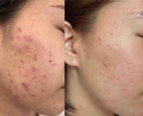 Vivian皮膚管理中心 - 案例介紹：油痘肌膚管理六次後改善紀錄