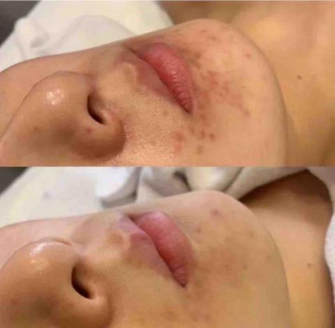 Vivian皮膚管理中心 - 案例介紹：油痘肌膚管理六次後改善紀錄