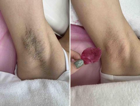 水水除毛美容｜健身❤️ - ♡腋下除毛♡毛髮留一公分才可以除～