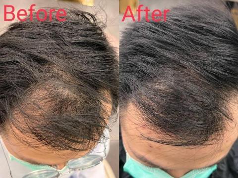 💎鑽泌頭面抗衰水光專家 - 頭皮育髮養髮