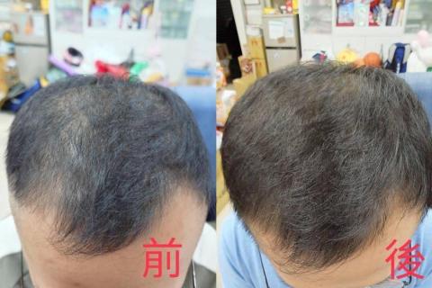 💎鑽泌頭面抗衰水光專家 - 頭皮育髮養髮