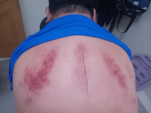 中部大技師 - 刮痧