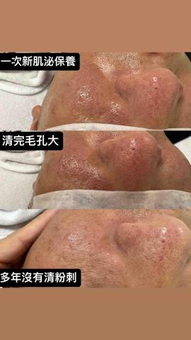 微膚顏美學 - 男性淨膚