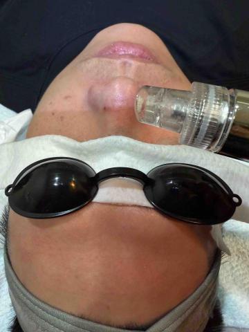 微膚顏美學 - 韓式清粉刺