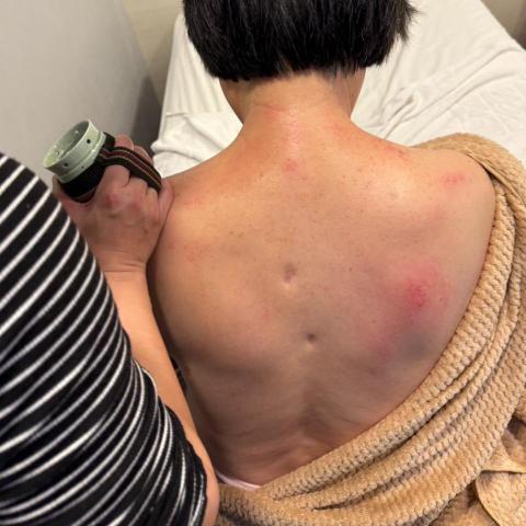 台中刮痧拔罐師傅推薦軒家艾草溫罐