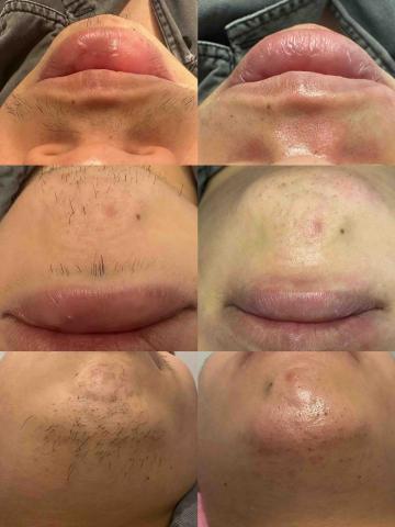 一絲不苟熱蠟美肌工作室 - 熱蠟兩週厚回除 毛髮變少許多 也不刺癢