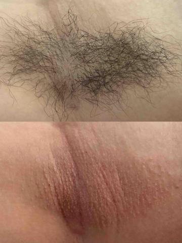 一絲不苟熱蠟美肌工作室 - 腋下熱蠟當下對比 立即無黑頭