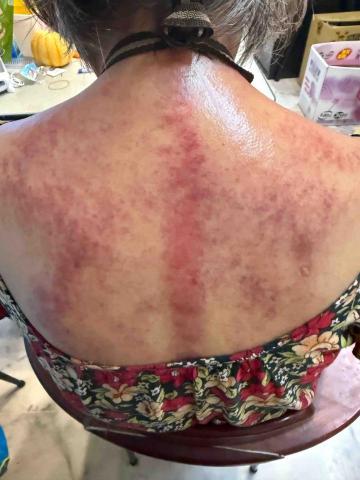 楊老師～15年的美容經驗，平日也是幼稚園的課後班老師，針對個 - 老奶奶家人想讓奶奶體驗溫罐，溫罐完才感受到原來身體有許多瘀堵