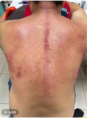 楊老師～15年的美容經驗，平日也是幼稚園的課後班老師，針對個 - 夫妻檔因為工作長期撈損，所以一起來體驗溫罐與牛角調理，搭配精油與刮痧把長期的氣瘀做舒緩調理