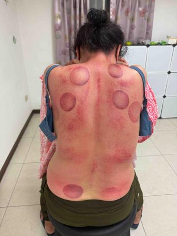 楊老師～15年的美容經驗，平日也是幼稚園的課後班老師，針對個 - 客戶常年上背及腰部酸痛，結合拔罐、牛角按摩與溫罐達到舒緩放鬆