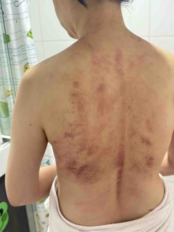 楊老師～15年的美容經驗，平日也是幼稚園的課後班老師，針對個 - 客戶自從乳癌化療後背部疼痛甚至無法入睡，結合溫罐與牛角按摩達到放鬆