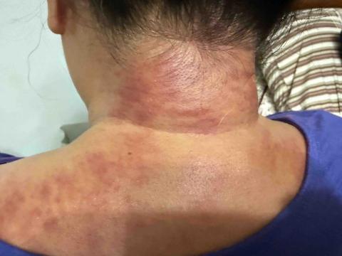 楊老師～15年的美容經驗，平日也是幼稚園的課後班老師，針對個 - 富貴包引起客戶長期頭痛，利用溫罐+刮痧把長期的氣瘀做調理