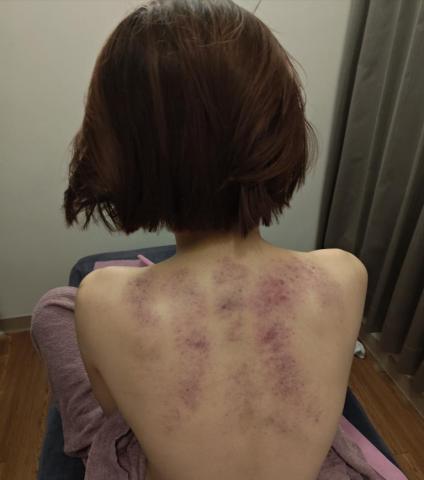 璟管放鬆 - 客人油壓後刮痧