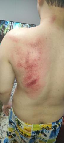 陳師傅按摩推拿工作室 - 肩胛關節筋膜沾黏處理