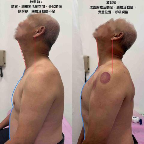 葉宗烜 - 矯正長期駝背、頭痛問題
