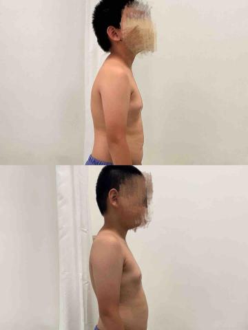 葉宗烜 - 小朋友矯正駝背前後對比