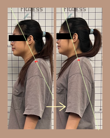 蕭仕茂 - 烏龜脖變化