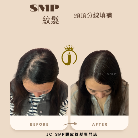 JC SMP 頭皮紋髮專門店 - SMP紋髮｜單針單點｜分線填補