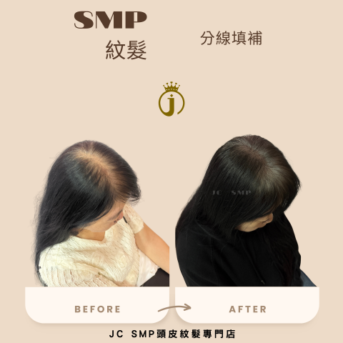 JC SMP 頭皮紋髮專門店 - SMP紋髮｜單針單點｜分線填補(白髮範例)