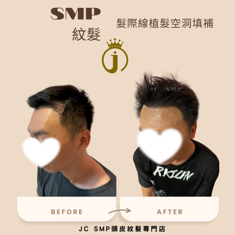 JC SMP 頭皮紋髮專門店 - SMP紋髮｜單針單點｜植髮後填補(植髮填補範例)