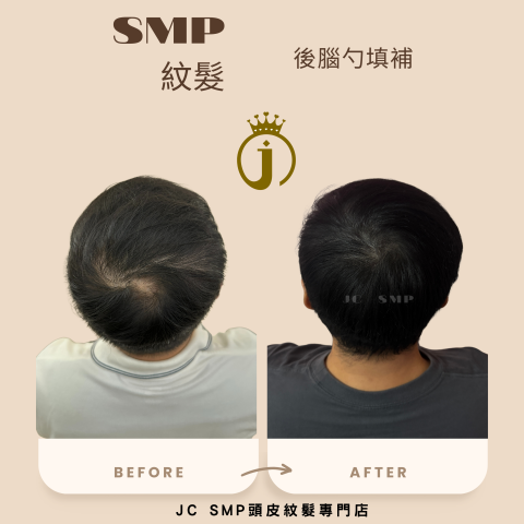 JC SMP 頭皮紋髮專門店 - SMP紋髮｜單針單點｜後腦勺大面積填補