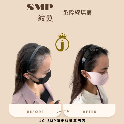 JC SMP 頭皮紋髮專門店 - SMP紋髮｜單針單點｜髮際線填補
