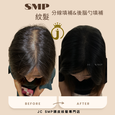 JC SMP 頭皮紋髮專門店 - SMP紋髮｜單針單點｜分線填補
