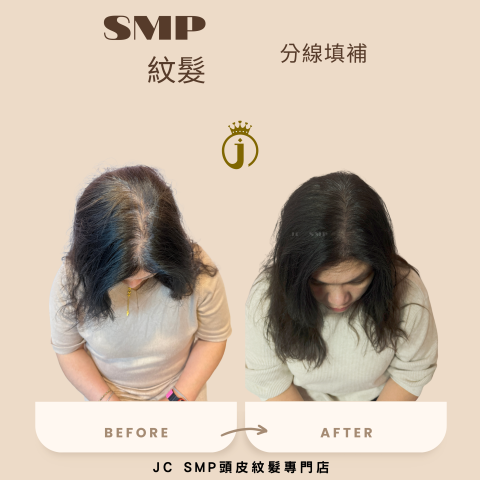 JC SMP 頭皮紋髮專門店 - SMP紋髮｜單針單點｜分線填補(白髮範例)