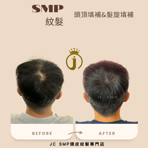 JC SMP 頭皮紋髮專門店 - SMP紋髮｜單針單點｜後腦勺填補