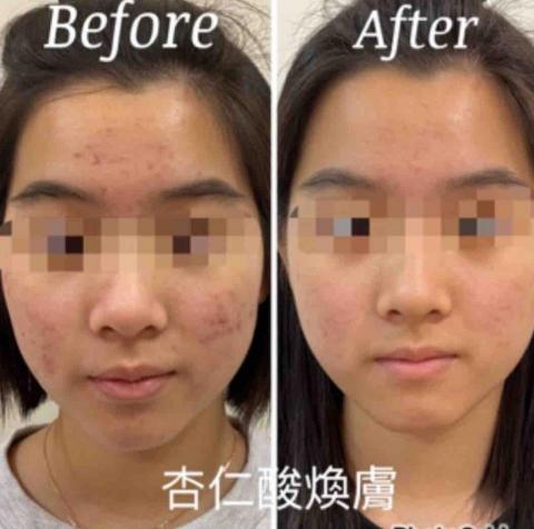 采采全方位美業到府服務～☺️ - 杏仁酸煥膚/大膿皰/閉鎖粉刺/角質肥厚/T字容易出油/杏仁酸3次之後的照片。