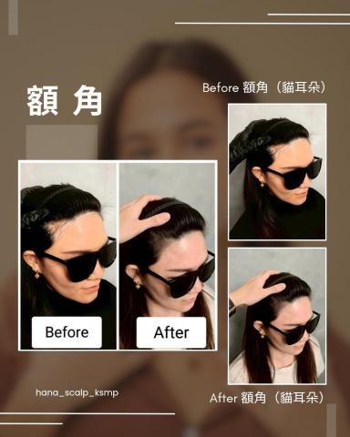 花紋 hana_scalp_ksmp - 隨便綁起馬尾 年輕氛圍感滿滿 
額角填補