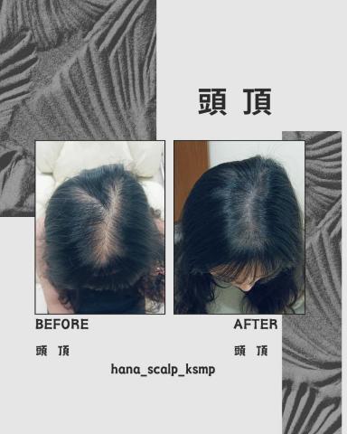 花紋 hana_scalp_ksmp - 頂部填補 自信年輕10歲