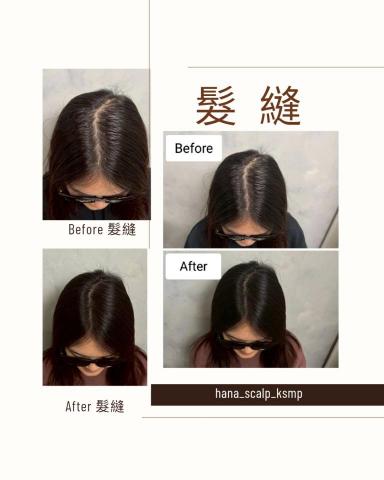 花紋 hana_scalp_ksmp - 髮縫空洞恢復自信