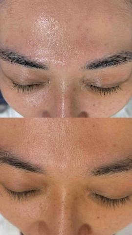 睫舞眉魔幻美學 - 微晶藻針前後對比