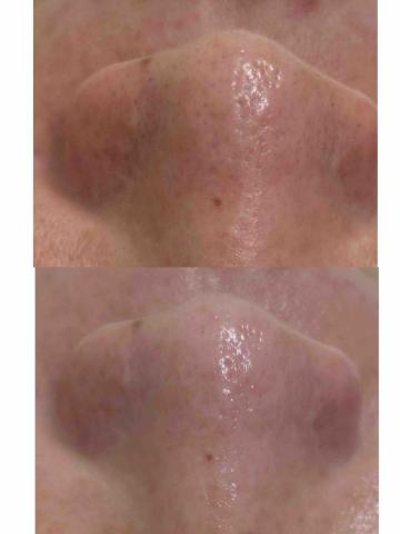 睫舞眉魔幻美學 - 微晶藻針課程對比照