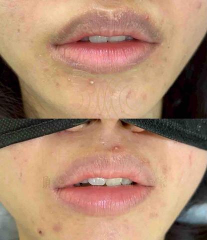 INHUE嶼容美學 - ✅ 唇色淡化／唇色修正（非霧唇）

唇色調整與淡化處理。針對原有唇色過重、不均或底色干擾，先進行評估與分階段處理，為後續設計保留彈性。適合曾做過紋唇、但對顏色不滿意者。
