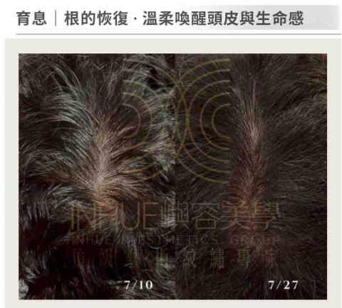 INHUE嶼容美學 - ✅科技蘊髮
藴髮並非承諾長出什麼，而是先把頭皮環境整理好，
讓它有機會慢慢回到穩定狀態。
操作前會評估頭皮狀況、生活作息與期待值，適合願意進行長期管理、不追求速效者。