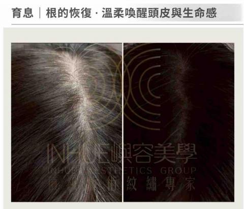 INHUE嶼容美學 - ✅科技蘊髮
藴髮並非承諾長出什麼，而是先把頭皮環境整理好，
讓它有機會慢慢回到穩定狀態。
操作前會評估頭皮狀況、生活作息與期待值，適合願意進行長期管理、不追求速效者。