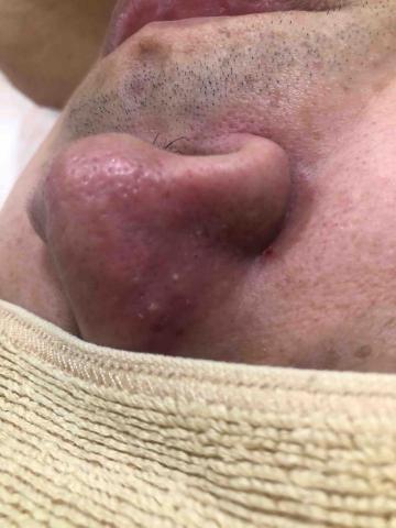 柚子舒壓坊-精油、舒壓，美容，SPA，按摩，經絡，推拿 - 臉部護膚手工清除粉刺、痘痘