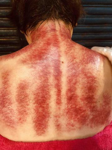 柚子舒壓坊-精油、舒壓，美容，SPA，按摩，經絡，推拿 - 艾草溫罐刮痧