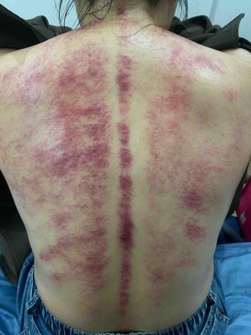 怡婷/耀朾精油溫罐&撥筋 - 體內濕氣重 睡不飽、身體沈重